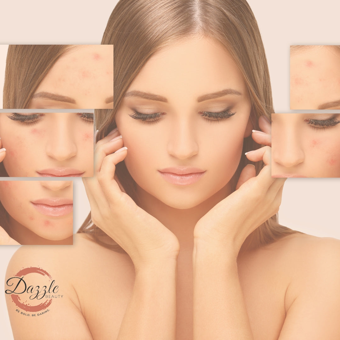 Defeat Summer Acne with Expert Tips !! Defeat Summer Acne with Expert Tips !!